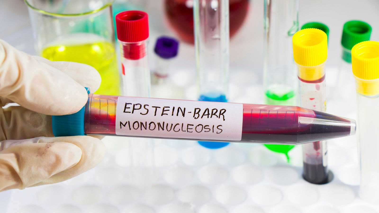 Mononukleóza a jej stanovenie vyšetrením vzorky krvi